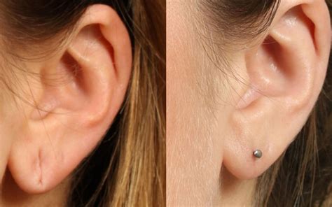 Best Earlobe Correction Repair Surgery Near Me In Coimbatore