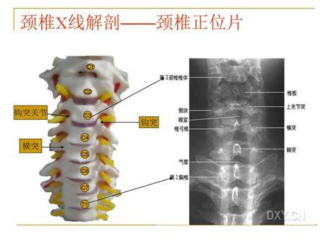 颈椎x线诊断 平高医院康复科 赵铎 Ppt Download