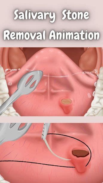 Asmrsatisfying Salivary Gland Stone Removal Animation