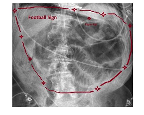 Imaging Case Of The Week 249 Answer Emergucate