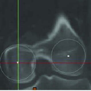 Measurement of linea aspera version. (A) Defining linea aspera using ...