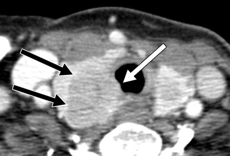 Locally Advanced Thyroid Cancer Can Ct Help In Prediction Of