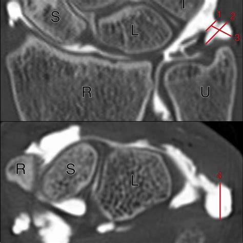 Schematic Display Of Different Prestyloid Recess Morphologies In