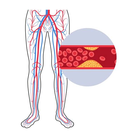 peripheral arterial disease explained  comprehensive guide