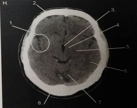 CT Head Anatomy H Quiz