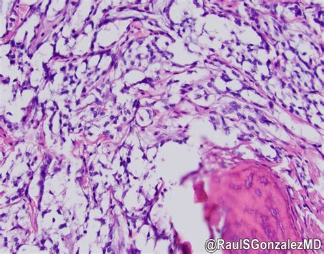 Pathology Outlines Well Differentiated Neuroendocrine Tumor