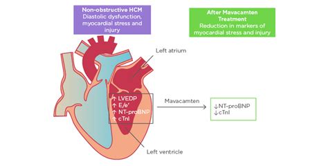 Hypertrophic Cardiomyopathy Wikipedia 50 Off