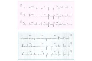 Heart Cardiogram Chart Vector Set Graphic By Pikepicture Creative