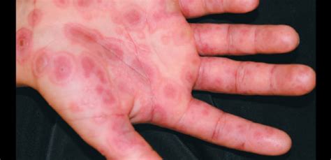 Pathogenesis Of Erythema Multiforme