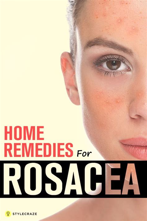 10 Home Remedies For Rosacea That Prevent Redness On The Skin Artofit