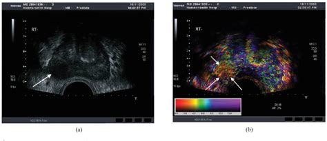 Figure From Applications Of Transrectal Ultrasound In Prostate