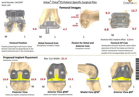 Case Study: Left Total Knee Arthroplasty - 66 year old male | Complete ...