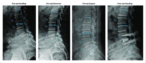 Case example: 61-year-old female presenting with 2 months of lower back ...