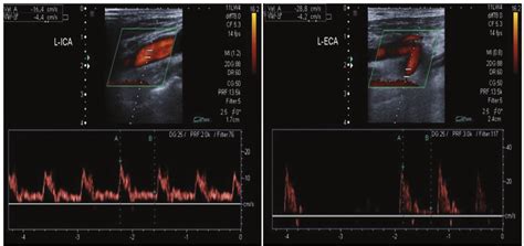 Carotid Ultrasound Waveforms