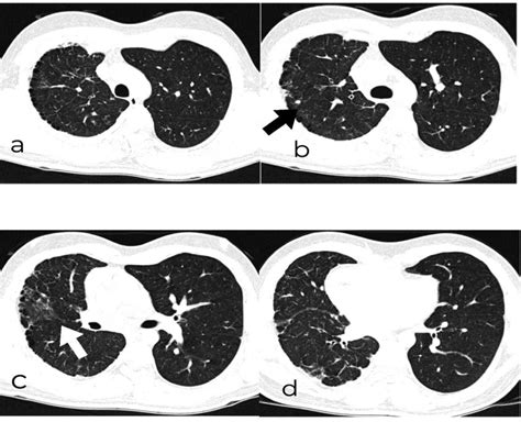 Year Old Male With Right Sided Proximal Interruption Of Pulmonary