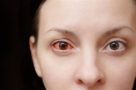 Ocular Rosacea Causes Symptoms Home Remedies And Lifestyle Tips