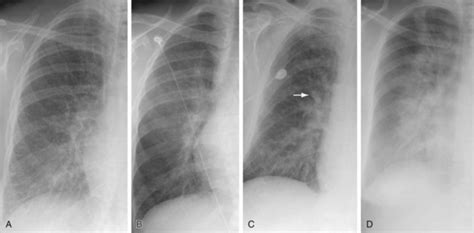 Pulmonary Edema X Ray Butterfly Pattern