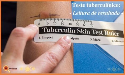 Diagn Stico Da Tuberculose