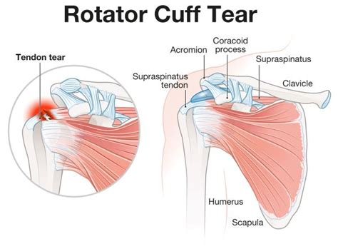 Can You Tear Your Rotator Cuff In A Car Accident