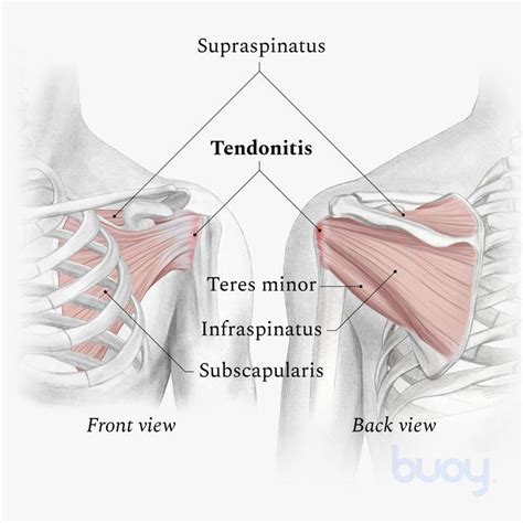 Rotator Cuff Tendonitis