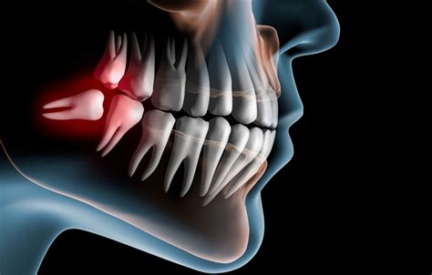 Extractions Wisdom Teeth Mid State Oral Surgery And Implant Center