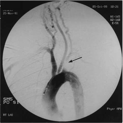 Arch Aortogram Showing Stenosis Of Left Subclavian Artery Arrow