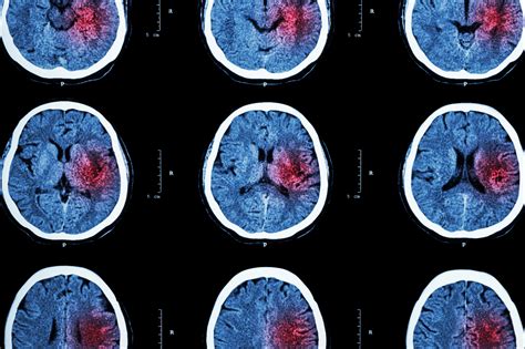 Ischemic Stroke: MedlinePlus