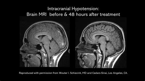 cranial-MRI-pre-post - Spinal CSF Leak Foundation