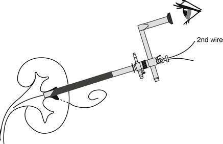 Complex PCNL and Antegrade Endopyelotomy | Abdominal Key