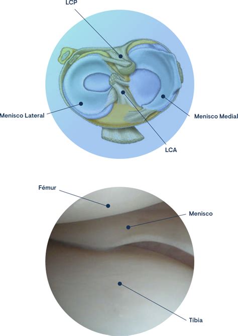 Menisco Clínica Do Joelho E Ombro Prof Gutierres Médicos E Ortopedia