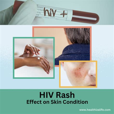 What Is Hiv Rash Symptoms And Treatments Healthizalife