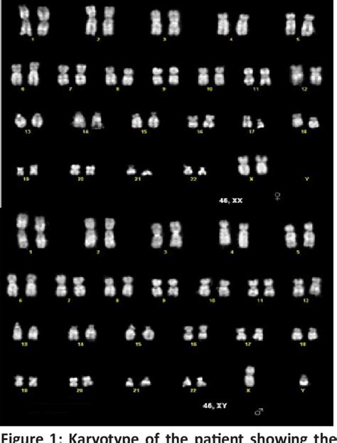 Figure 1 From Management Challenges Of Disorders Of Sex Development