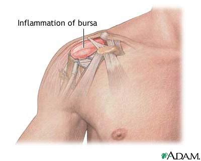 shoulder-bursitis - Singapore Sports and Orthopaedic Clinic