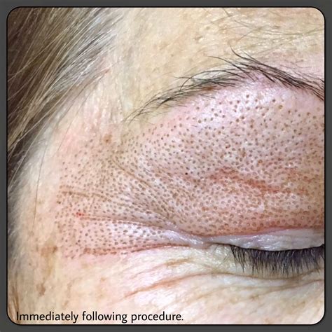 full face fibroblast before and after