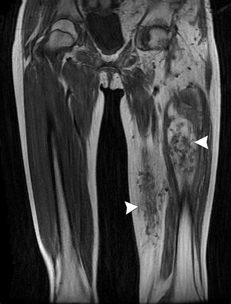 Case 289 Pik3ca Related Overgrowth Spectrum Pros Cloves Syndrome