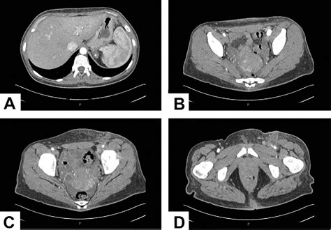 Figure 3 From A Case Of External Iliac Arteriovenous Fistula And High