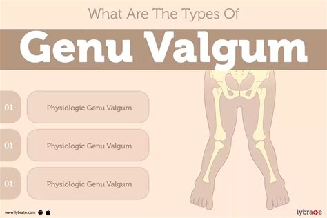 Genu Valgum Treatment