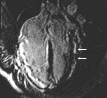 Imagerie Dysplasie Arythmog Ne Du Ventricule Droit