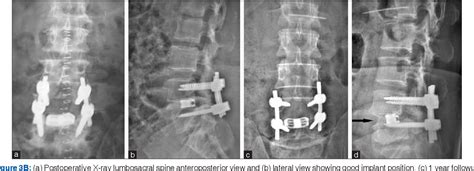 Figure 1 From Comparison Of The Early Results Of Transforaminal Lumbar Interbody Fusion And