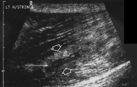 Sonography Of Lower Limb Muscle Injury Ajr