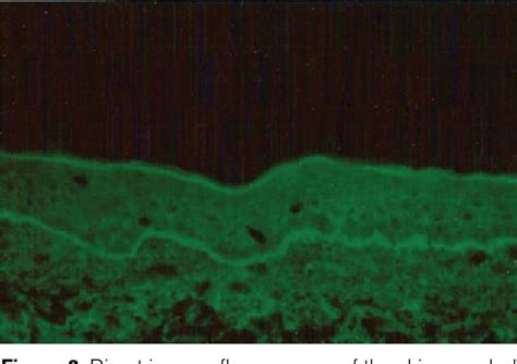 Figure From Drug Induced Linear Immunoglobulin A Bullous Dermatosis