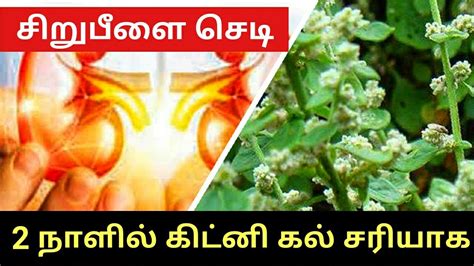 Kidney Stone Remove Sirupeelai Sedi கிட்னி கல் சிறுநீரக கல்