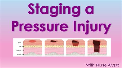 Pressure Ulcer Staging