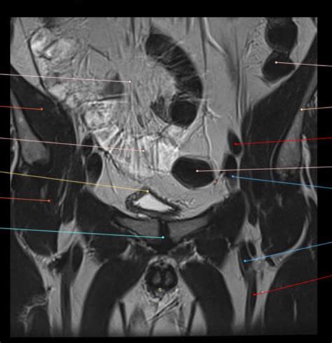 Diagram Of Male Pelvis Coronal Mri 2 Quizlet