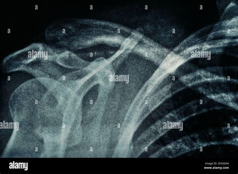 R Ntgenbild Der Schulter Fotos Und Bildmaterial In Hoher Aufl Sung