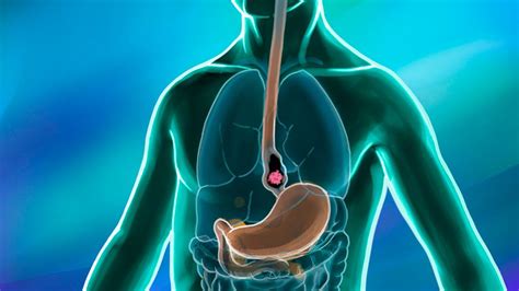 What is Esophageal Cancer? Symptoms, Risk Factors & Treatments | MD ...