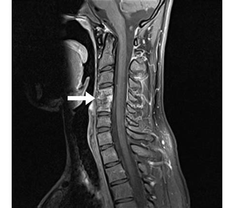 Osteomyelitis Mri Spine