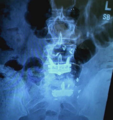 Lumbosacral spine x ray | Syrinx Asylum