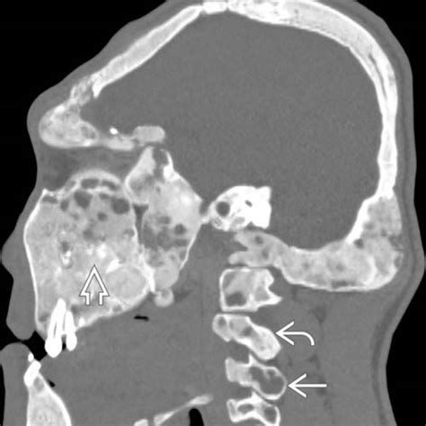 Polyostotic Fibrous Dysplasia