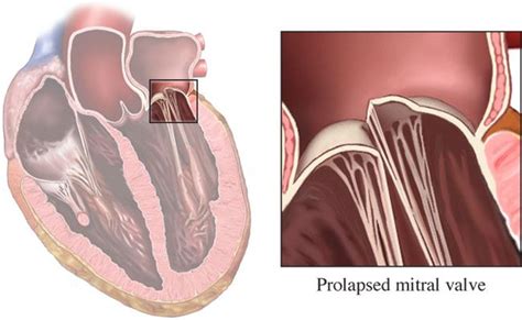 Mitral Valve Disease Treatment In New Jersey